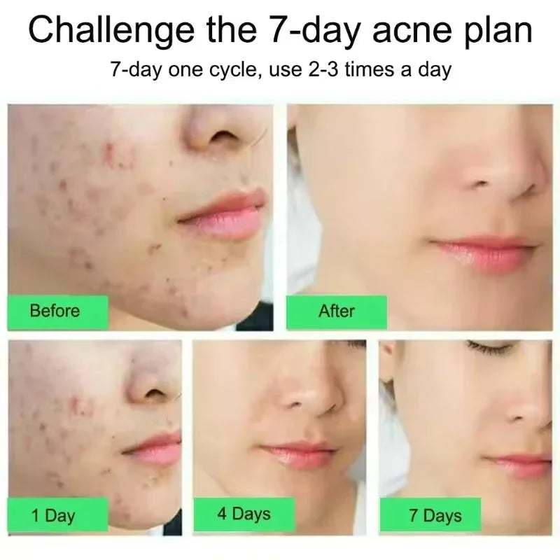 Crème Anti-bouton a l'Acide Salicylique - Soin Purifiant