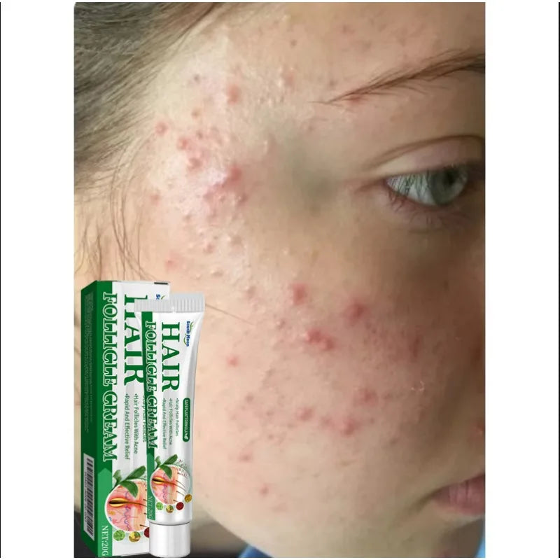 Crème anti-acné & anti-boutons – Élimine nodules, kystes, points noirs & imperfections