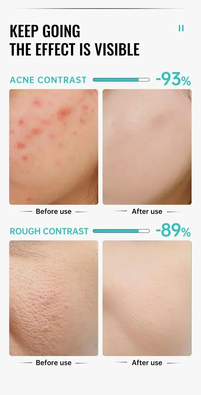 Crème Anti-bouton a l'Acide Salicylique - Soin Purifiant