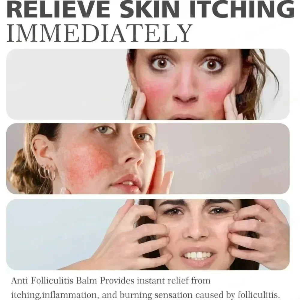 Crème anti-acné & anti-boutons – Élimine nodules, kystes, points noirs & imperfections