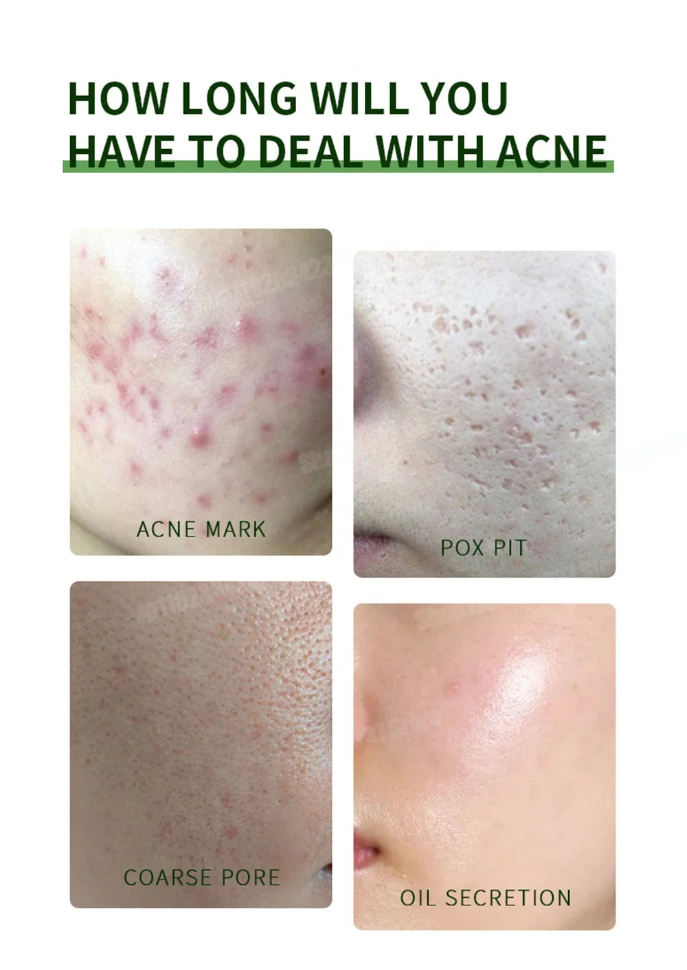 Crème anti-acné & anti-boutons – Élimine nodules, kystes, points noirs & imperfections
