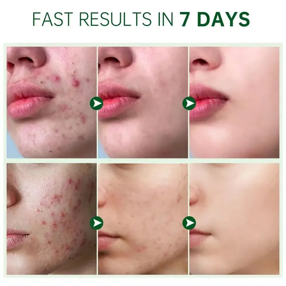 Crème Anti-bouton a l'Acide Salicylique - Soin Purifiant