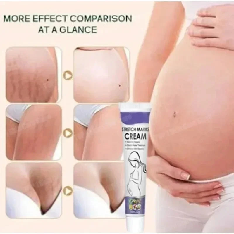 Skin Care Improves Elasticity Effective After Pregnancy Stretch Marks Removal Powerful Maternity Cream Nourishes Skin