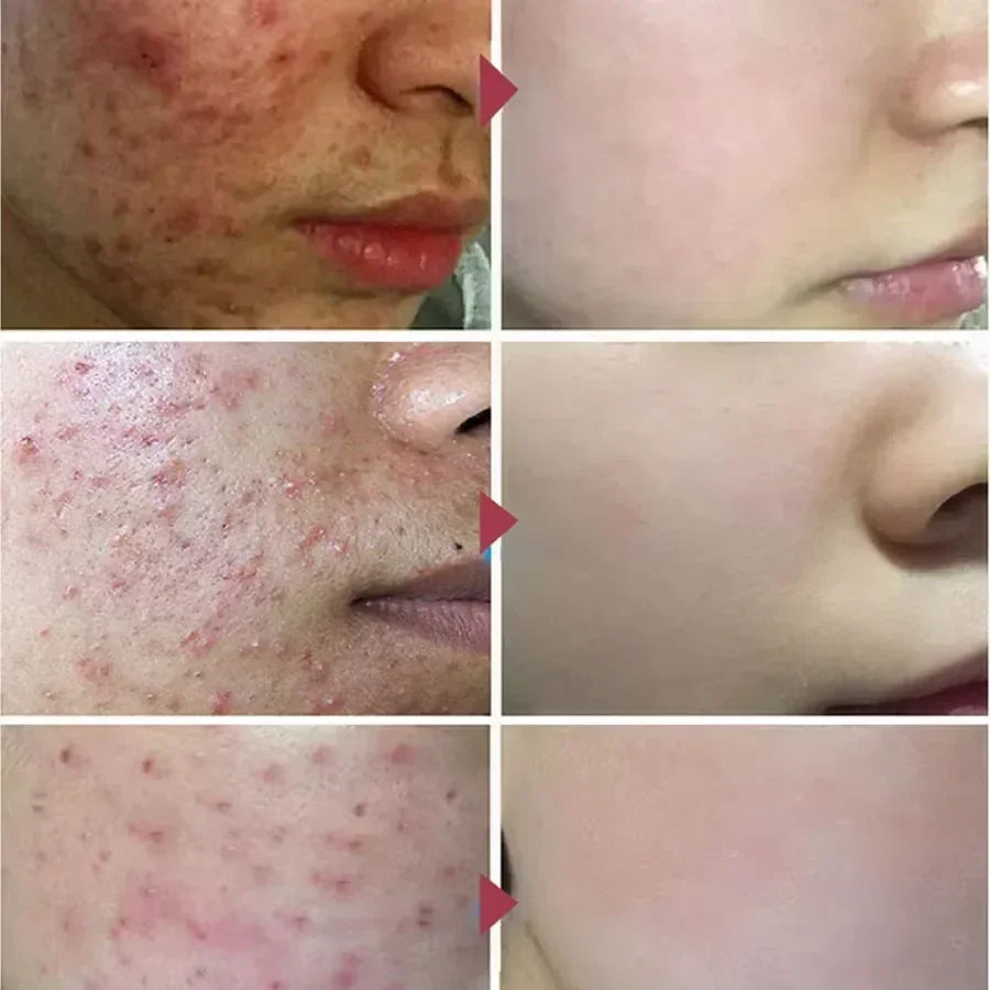 Crème Anti-bouton a l'Acide Salicylique - Soin Purifiant
