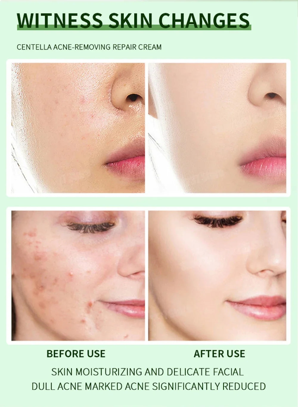 Crème anti-acné & anti-boutons – Élimine nodules, kystes, points noirs & imperfections