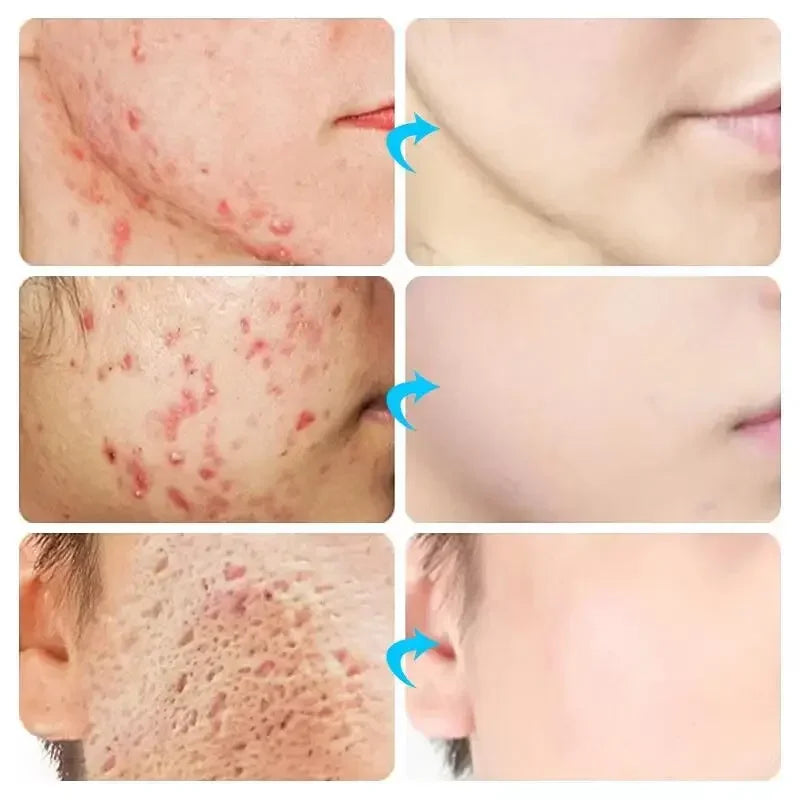 Crème Anti-bouton a l'Acide Salicylique - Soin Purifiant