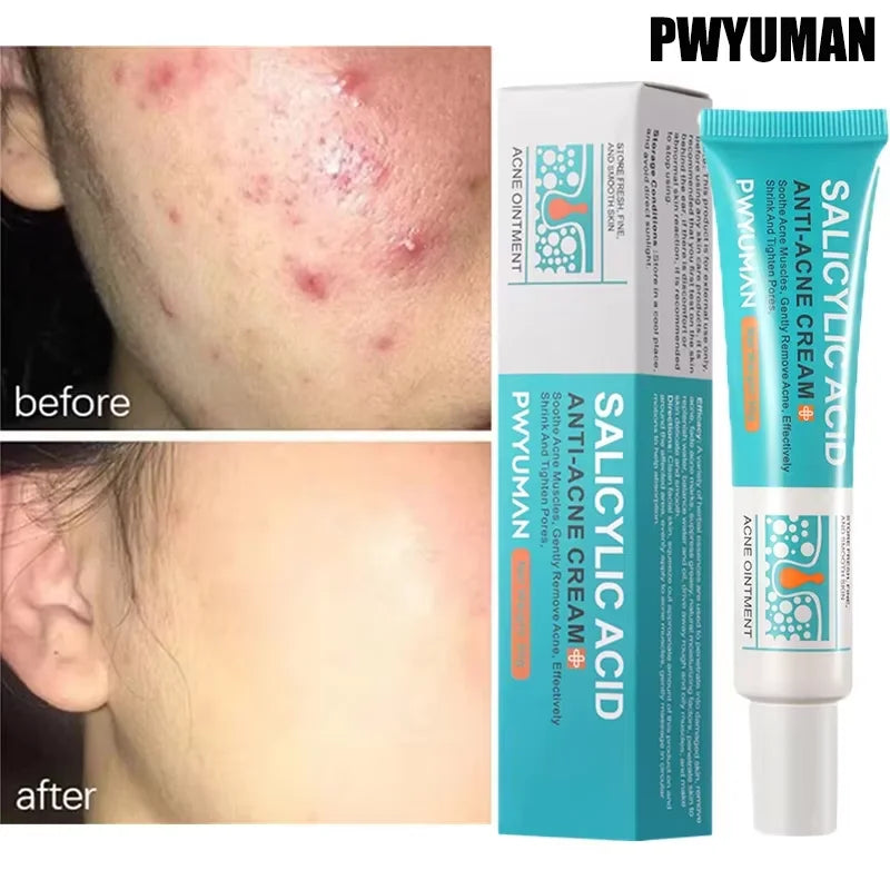 Crème Anti-bouton a l'Acide Salicylique - Soin Purifiant
