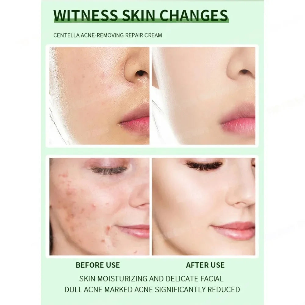 Crème anti-acné & anti-boutons – Élimine nodules, kystes, points noirs & imperfections