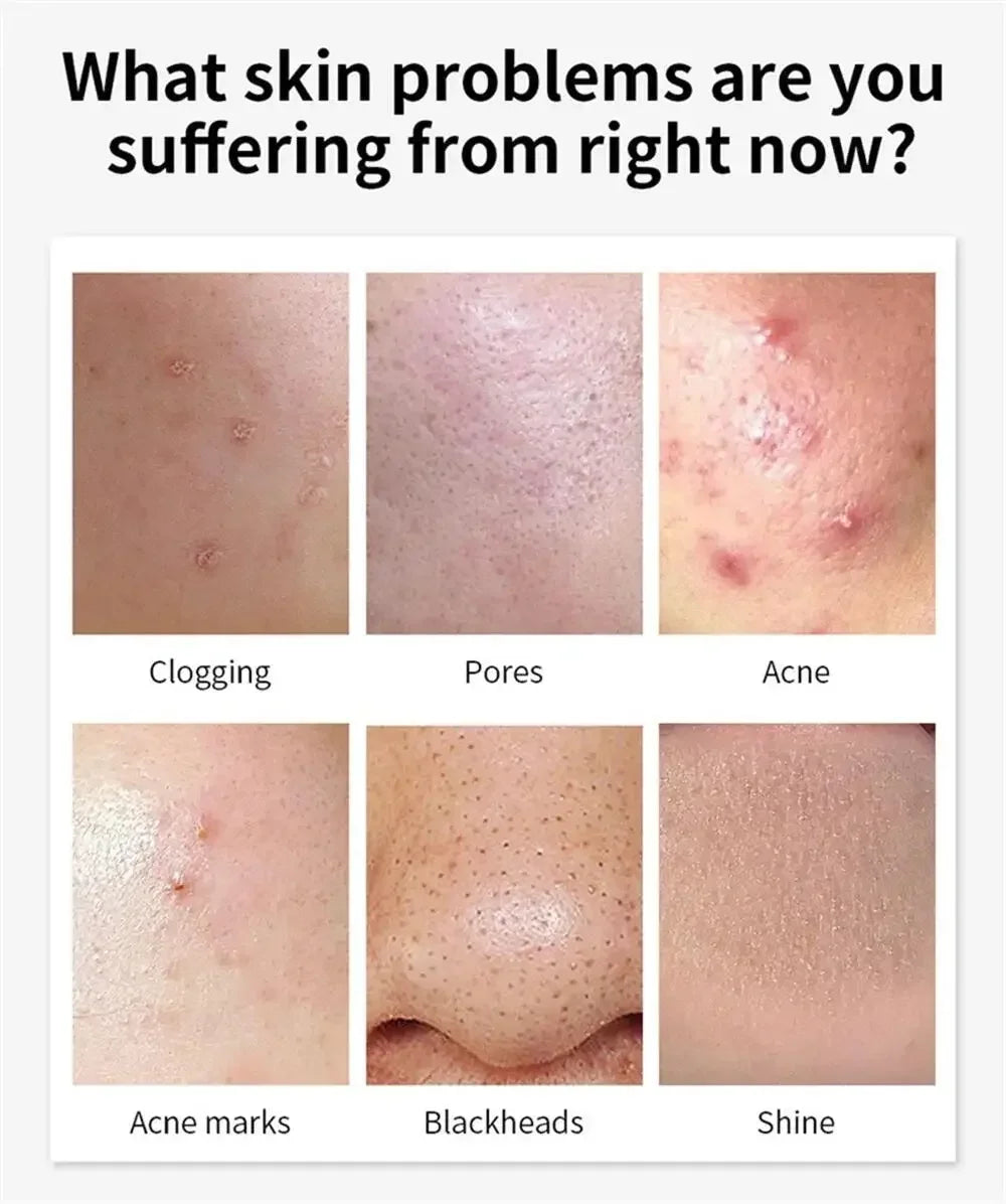 Crème Anti-bouton a l'Acide Salicylique - Soin Purifiant