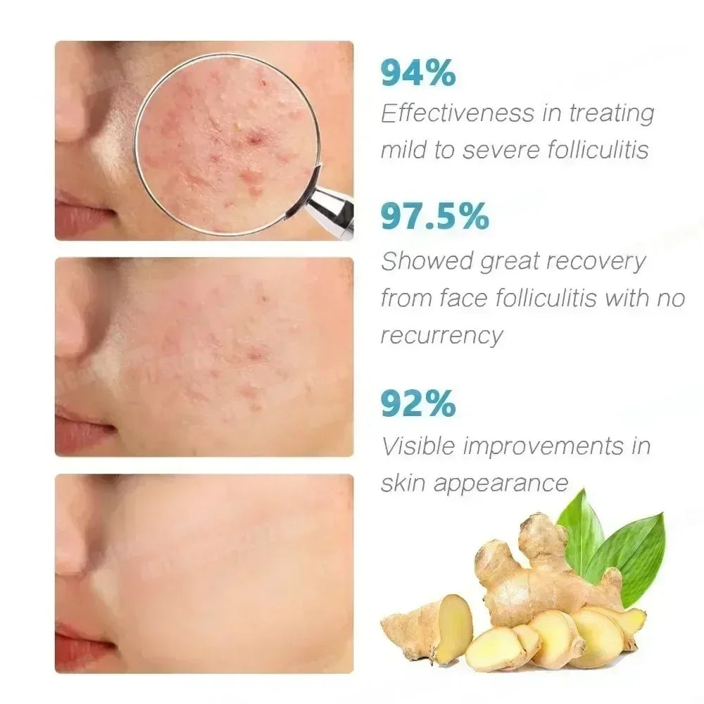 Crème anti-acné & anti-boutons – Élimine nodules, kystes, points noirs & imperfections
