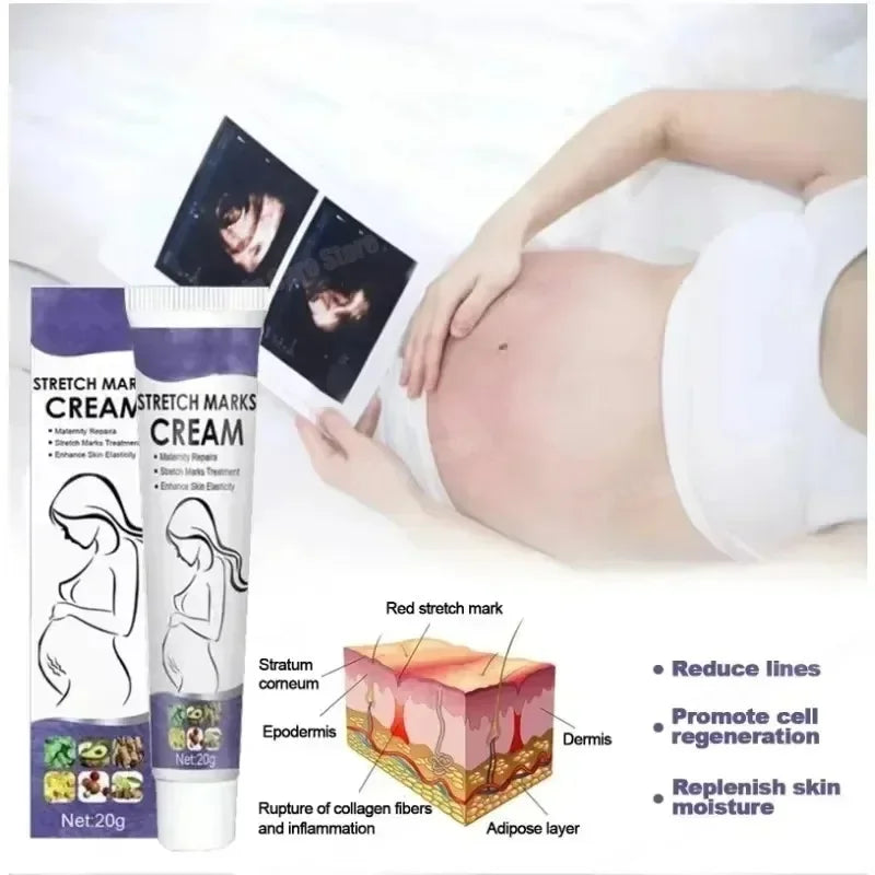 Skin Care Improves Elasticity Effective After Pregnancy Stretch Marks Removal Powerful Maternity Cream Nourishes Skin