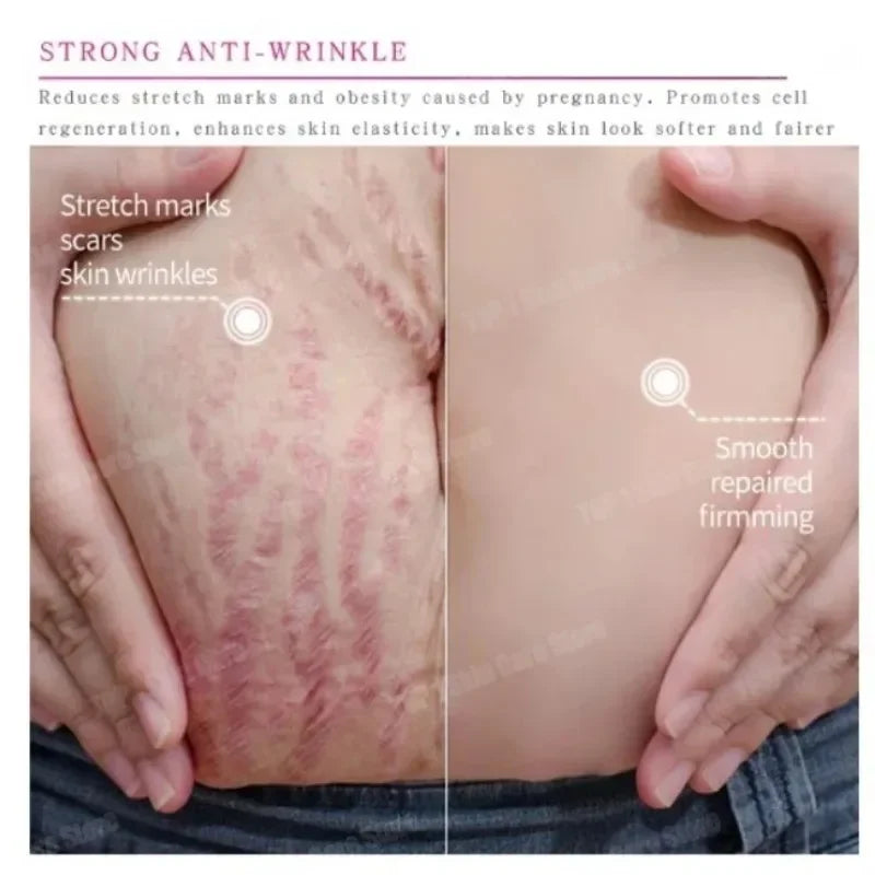 Skin Care Improves Elasticity Effective After Pregnancy Stretch Marks Removal Powerful Maternity Cream Nourishes Skin