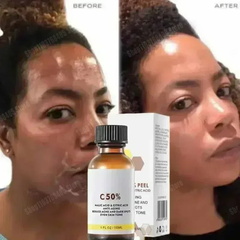 Essence anti-acné & anti-taches – Exfoliant chimique à l'acide salicylique, Anti-âge & Hydratante