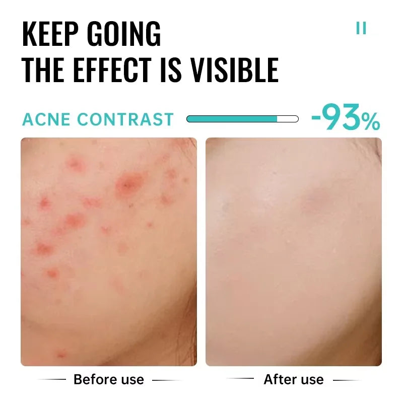 Crème Anti-bouton a l'Acide Salicylique - Soin Purifiant