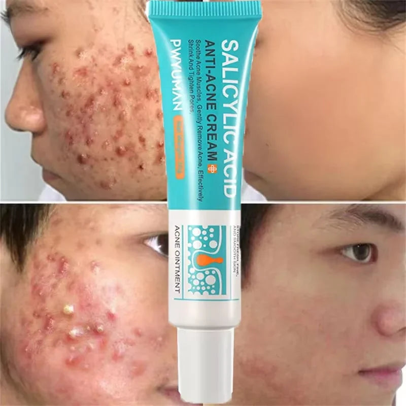 Crème Anti-bouton a l'Acide Salicylique - Soin Purifiant