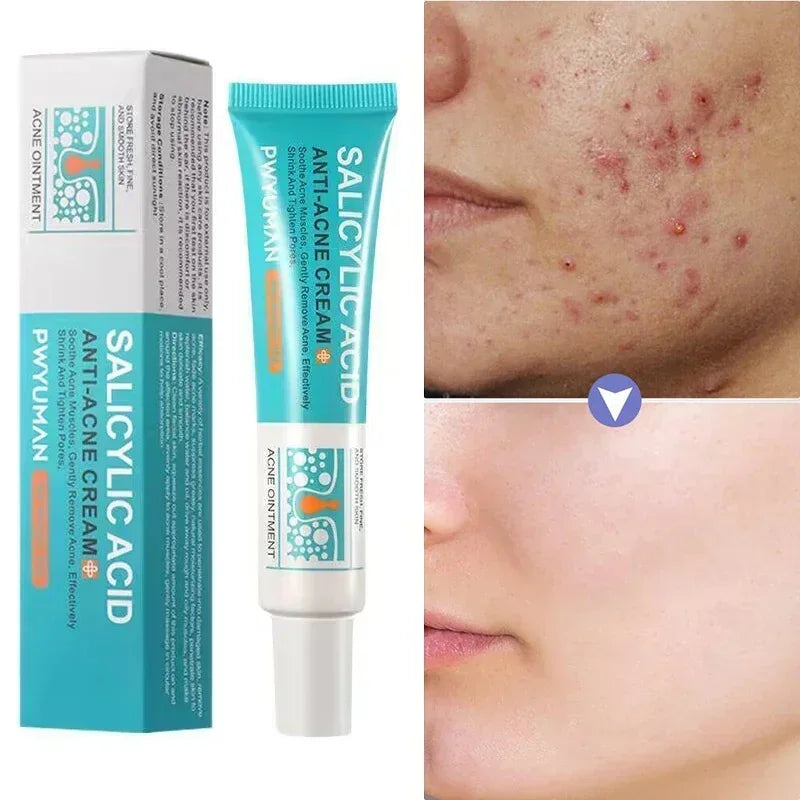 Crème Anti-bouton a l'Acide Salicylique - Soin Purifiant