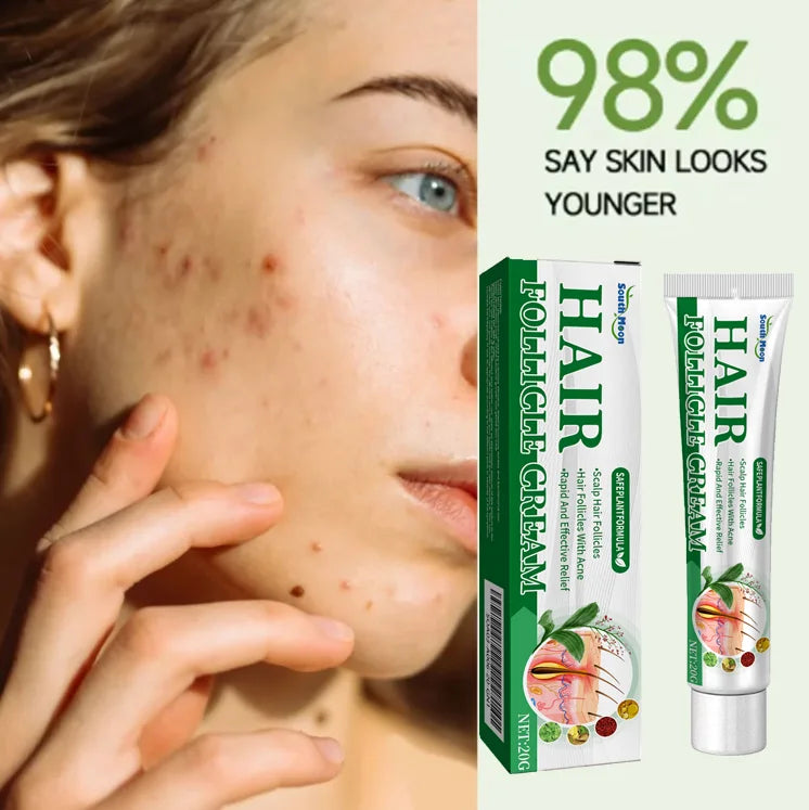 Crème anti-acné & anti-boutons – Élimine nodules, kystes, points noirs & imperfections