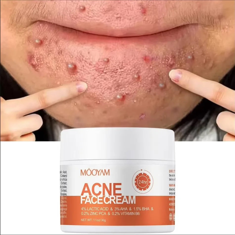 Crème Anti-Acne aux Herbes PWYUMAN - Soin Purifiant en profondeur